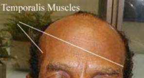 temporalis muscles