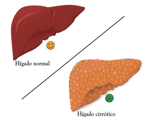 Illustration showing a healthy liver, with a smooth surface, next to a cirrhotic liver, with a mottled surface, for comparison.