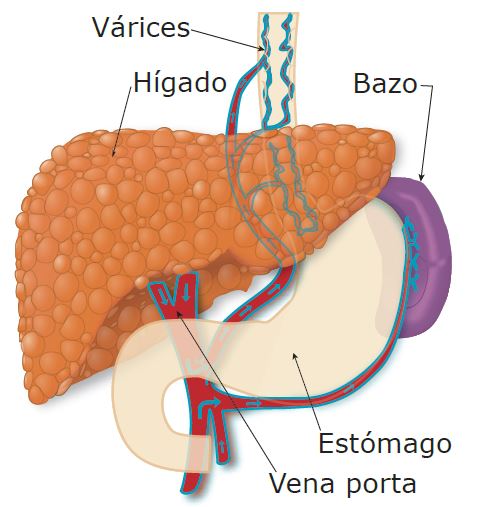 Illustration showing a cirrhotic liver and varrices, and the nearby liver, spleen, and portal vein.