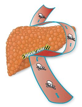 Illustration showing blood unable to flow through a cirrhotic liver.