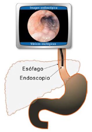 Illustration of the liver, stomach, and esophagus with a lighted tube in it. At the top is a photograph of an endoscopic image showing esophogeal varices.