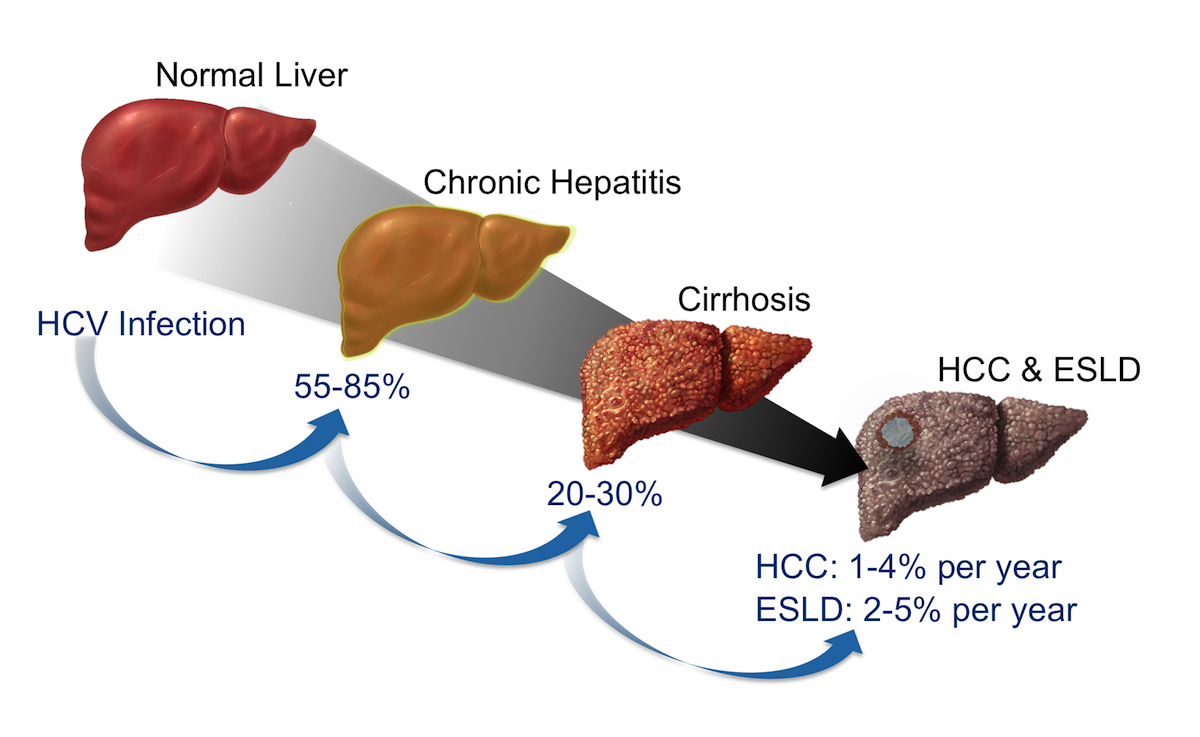progression of hepatitis