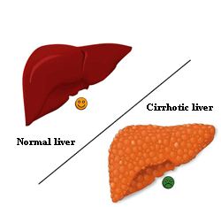 A normal liver versus a cirrhotic liver